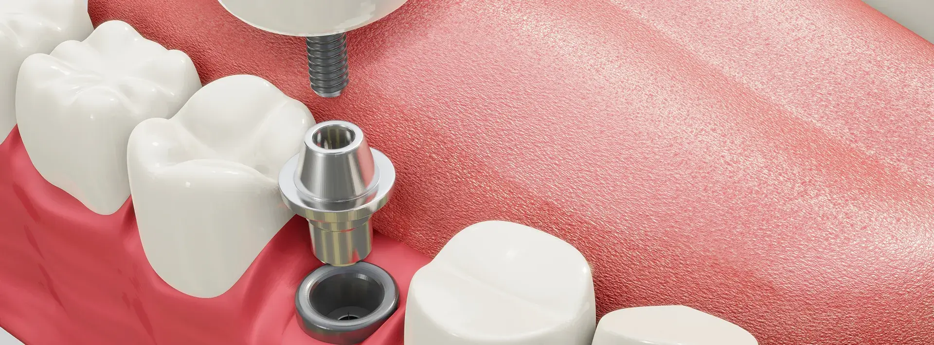 Implantes dentales en Chamartín